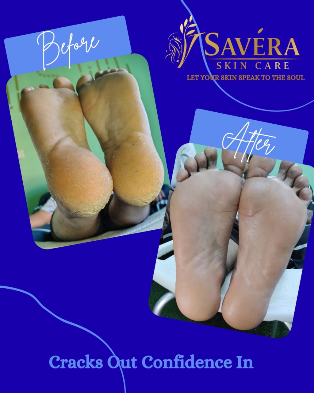 Savera skin care Foot cracks removal gel + 1 stainless steel foot file