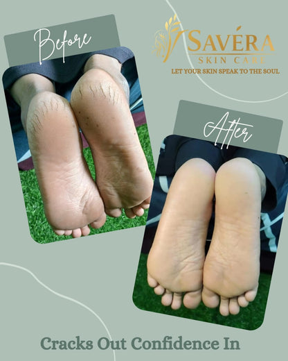 Savera skin care Foot cracks removal gel + 1 stainless steel foot file