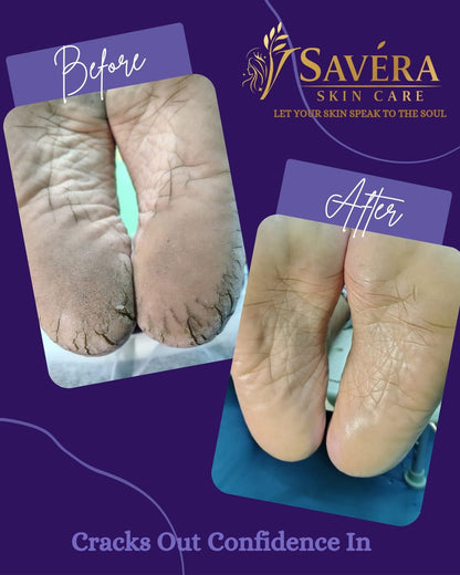 Savera skin care Foot cracks removal gel + 1 stainless steel foot file