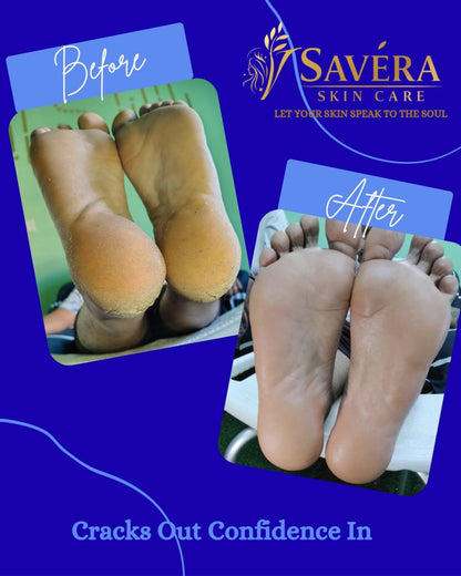 Savera skin care Foot cracks removal gel + 1 stainless steel foot file